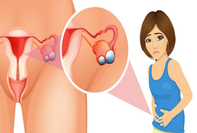 4 điều cần lưu ý khi bị u xơ tử cung